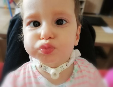 Ninkin vývoj už v brušku naznačoval, že bude po narodení čeliť viacerým komplikáciám